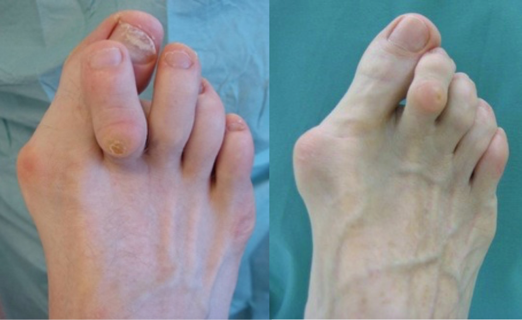 Hallux Valgus Treatment and Recovery > Sincerus Orthopaedics